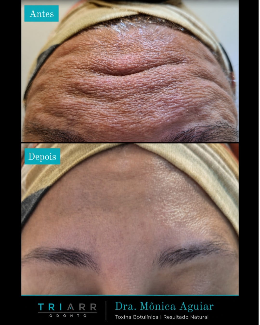 A Harmonização Orofacial não é sobre mudar quem você é. É sobre realçar o que já existe.
Este é o resultado do trabalho da Dra. Mônica Aguiar com toxina botulínica — natural, sutil e focado na harmonia do seu rosto.
Cada tratamento é personalizado, porque cada rosto tem sua própria beleza. 🤍

#TriarrOdonto #HarmonizacaoOrofacial #ToxinaBotulinica #Copacabana #DraMonicaAguiar